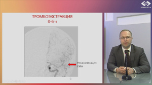 Ишемический инсульт: от лечения к выбору оптимального режима вторичной профилактики