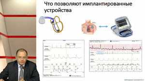 Перипроцедуральная антикоагуляция при проведении мероприятий по восстановлению ритма при фибрилляции предсердий