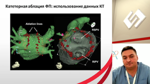 Интервенционное лечение фибрилляции предсердий