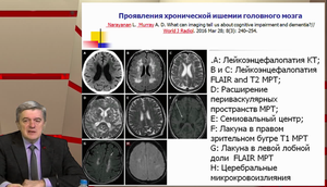 VI Международный Интернет Конгресс специалистов по внутренним болезням. День 2. Симпозиум «Дисциркуляторная энцефалопатия: диагностика и лечение. Когнитивные расстройства у пациентов с артериальной гипертензией»