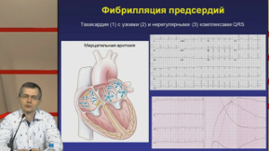 Нарушение ритма сердца 