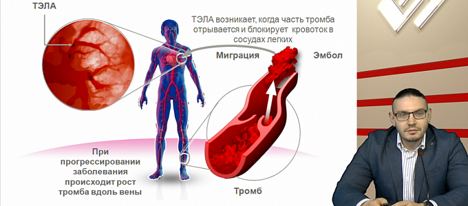 Все что нужно знать о современной антикоагулянтной терапии венозных тромбоэмболических осложнений: исследования, рекомендации, реальная клиническая практика. Взгляд сосудистого хирурга.