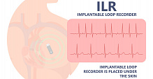 Скрининг ФП петлевым регистратором и риск инсульта