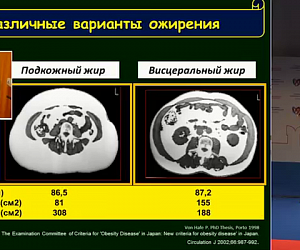 Артериальная гипертензия и метаболический синдром