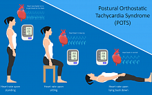Синдром постуральной ортостатической тахикардии: простое решение сложной проблемы