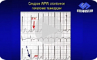 Cиндром и феномен Вольфа-Паркинсона-Уайта: лечить или оперировать?
