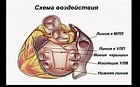 Торакоскопическая аблация в лечении фибрилляции предсердий