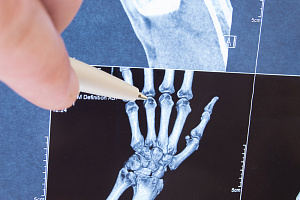 Рутинное рентгенологическое исследование кистей при подозрении на ревматоидный артрит поставлено под сомнение
