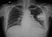 Имплантировать ли кардиовертер-дефибриллятор пациентам с ХБП, подумайте дважды 